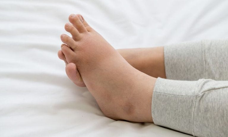 Πρησμένα πόδια λόγω κατακράτησης υγρών: Πώς θα το αντιμετωπίσετε