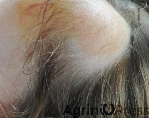 Αγρίνιο: Σοκαριστικό ατύχημα σε νηπιαγωγείο- Ξεριζώθηκαν τα μαλλιά 5χρονης (φωτο)