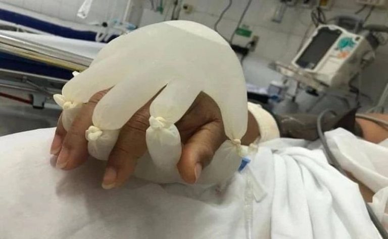 Βραζιλία – «Το χέρι του Θεού»: Τα γάντια με ζεστό νερό σε ασθενείς με κορονοϊό για να μη νιώθουν μόνοι