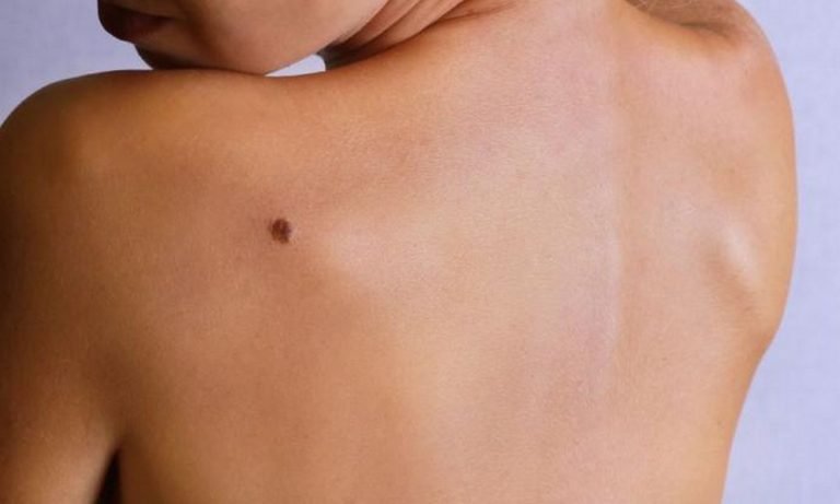 Καρκίνος του δέρματος: Τι σημαίνει φαγούρα σε ελιές