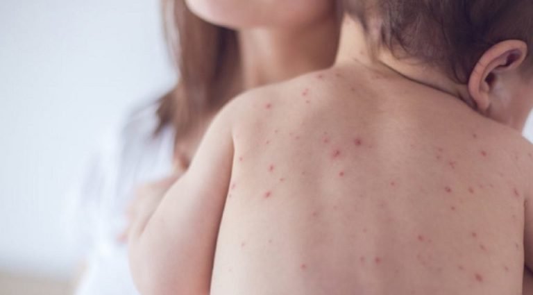 Εξήντα έξι περιστατικά ιλαράς στη Βουλγαρία-Τα περισσότερα σε μικρά παιδιά