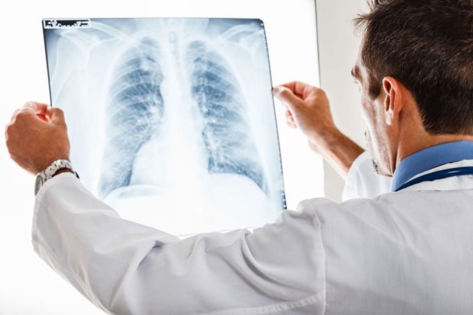 Έρευνα αποκαλύπτει τις επιπτώσεις που προκαλεί ο κορωνοϊός στους πνεύμονες