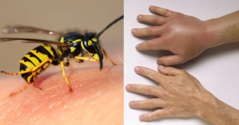 Τσίμπημα σφήκας ή μέλισσας: Τι πρέπει να κάνουμε άμεσα – Πώς φεύγει ο πόνος