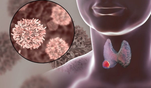 Καρκίνος του θυρεοειδούς: Σημάδια και συμπτώματα που πρέπει να ξέρετε