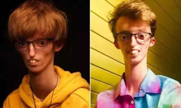 Σύνδρομο MDP