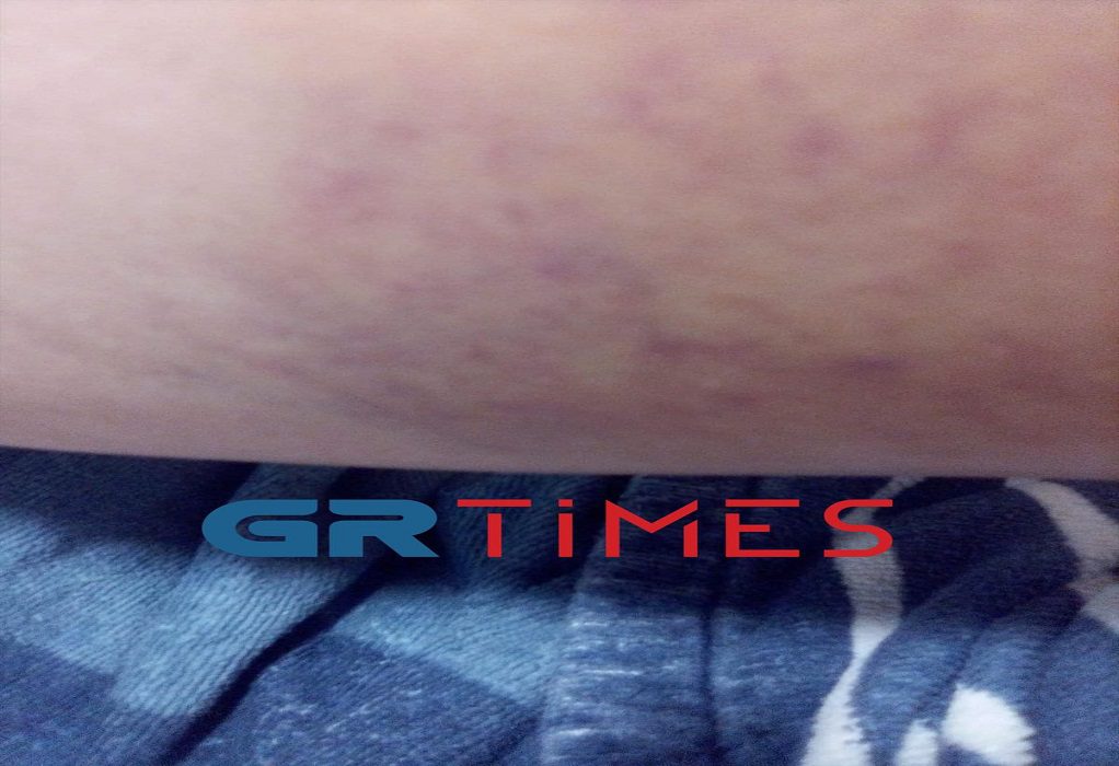 40χρονη για ινστιτούτο αισθητικής: Μου έταξαν μεταμόρφωση και βρέθηκα… παραμορφωμένη