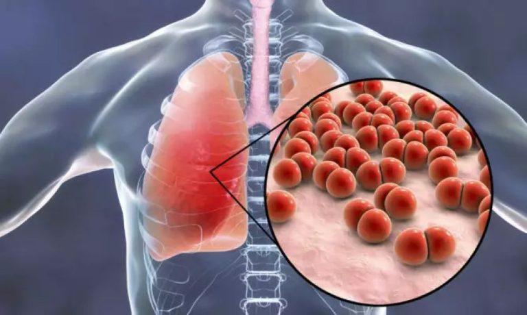 Πνευμονιόκοκκος: Πώς μεταδίδεται, τι συμπτώματα έχουν οι λοιμώξεις που προκαλεί και πώς να προστατευθείτε