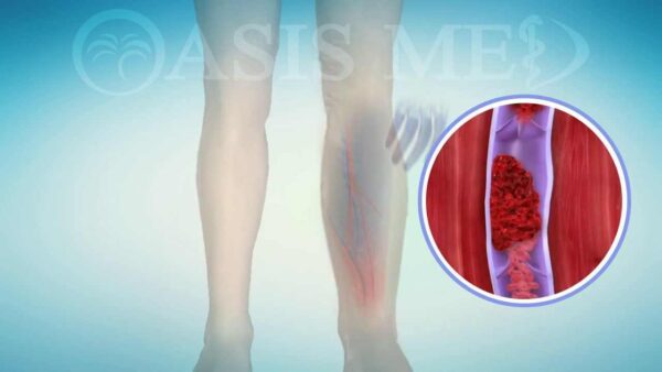 Παγκόσμια Ημέρα Θρομβώσεων