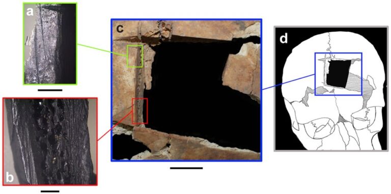 Αρχαιολογία: Ο άνθρωπος με μια τετράγωνη τρύπα στο κρανίο του- Ένδειξη για χειρουργική εγκεφάλου πριν 3.500 χρόνια στο Ισραήλ