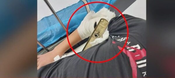 Πώς καρφώθηκε πόμολο στο μπράτσο μαθητή σε σχολείο του Βόλου – Έφτασε δίπλα στο κόκκαλο