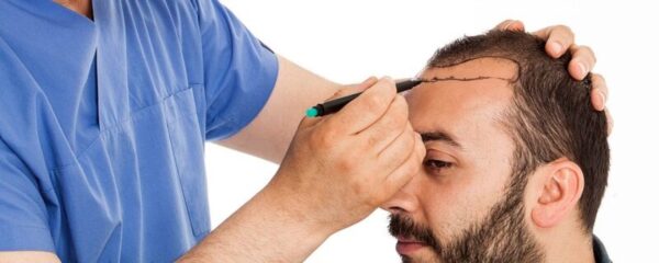 Μεταμόσχευση μαλλιών: Σύγχρονες έννοιες και τεχνικές