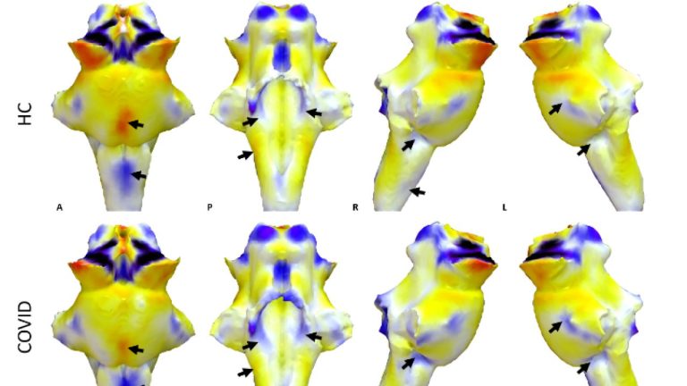 Η βλάβη στο εγκεφαλικό στέλεχος υπεύθυνη για τα συμπτώματα του μακροχρόνιου Covid