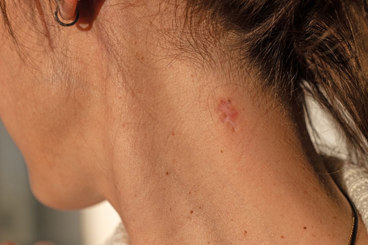 kokkina-simadia-sto-derma Κόκκινα σημάδια στο δέρμα – Τι μπορεί να σημαίνουν για την υγεία μας