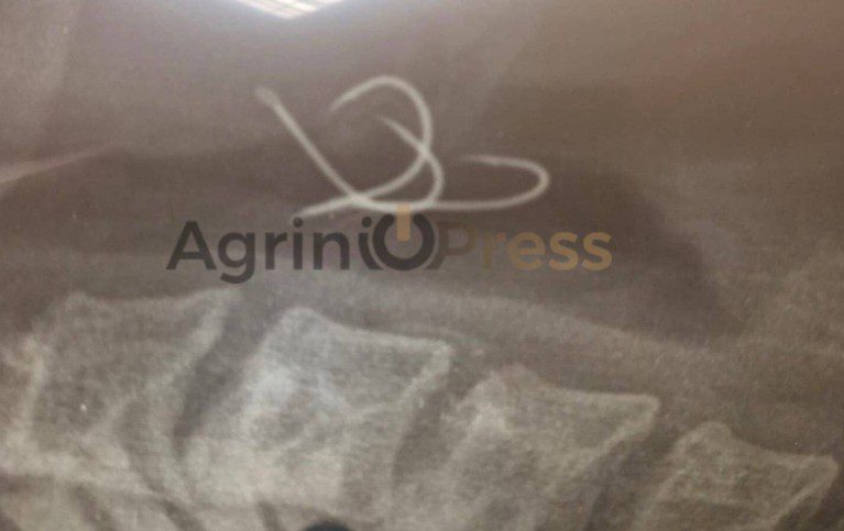 Αγρίνιο: 38χρονος έφαγε χταπόδι μαζί με το αγκίστρι- Δείτε ακτινογραφία